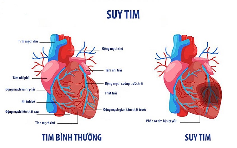 Suy tim là biến chứng hay gặp, chiếm khoảng 25 đến 30% các trường hợp NMCT